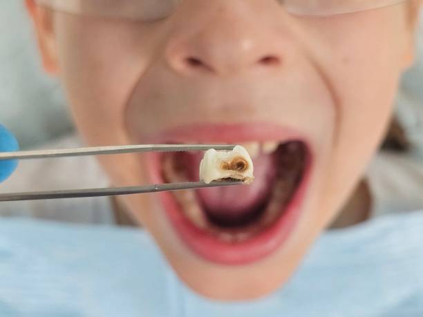Best Emergency Dental Extractions in Pagould, AR